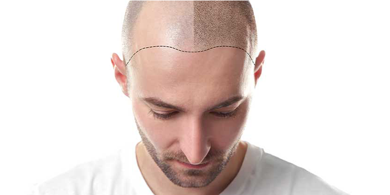 Saç Ekiminde Fue Tekniği