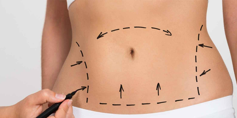 Abdominoplastik