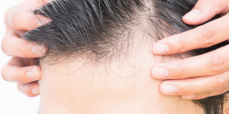 Traşsız Saç Ekimi