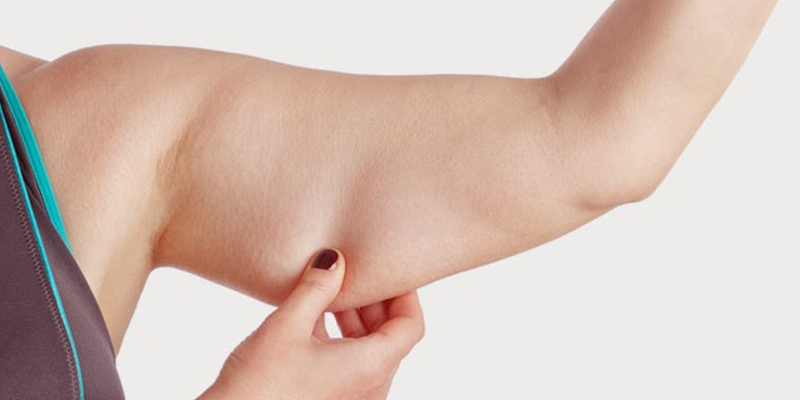 Arm Lift (Brachioplasty)