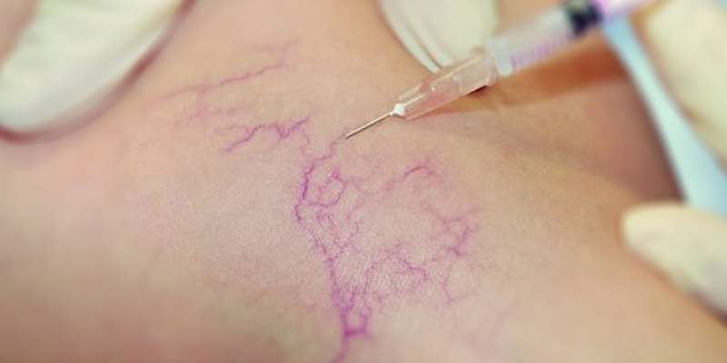 Treatment Of Varicose