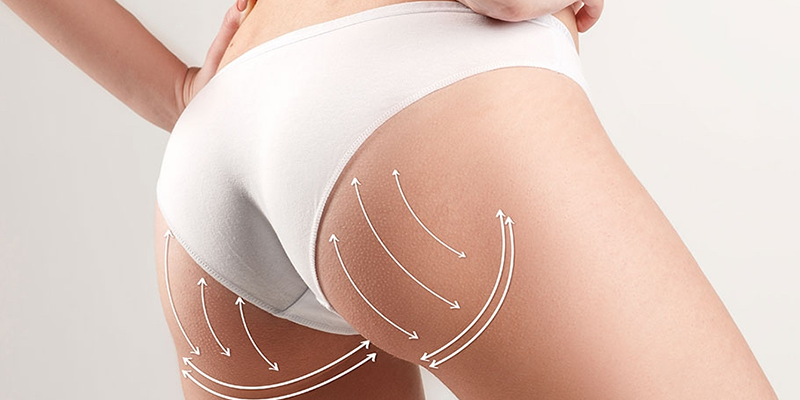 Brazillian Butt Lift(Bbl)