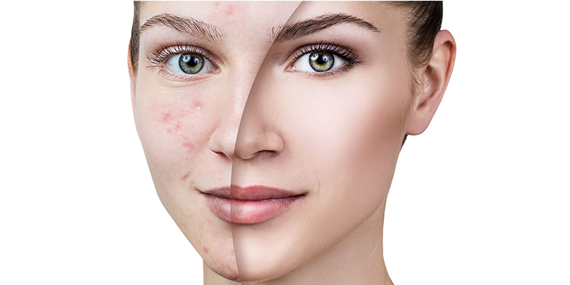 Dermabrazyon